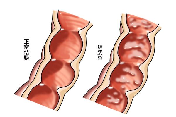 两个月小孩不拉屎的原因分析及应对方法