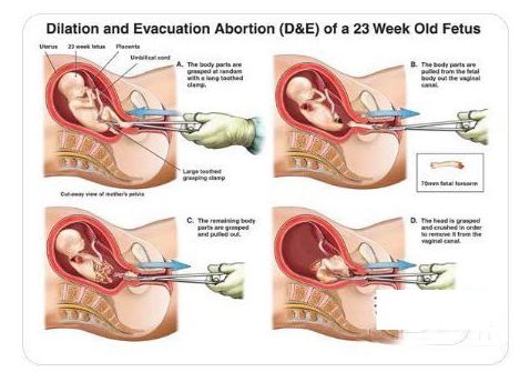几个月人流手术最好的全面解析