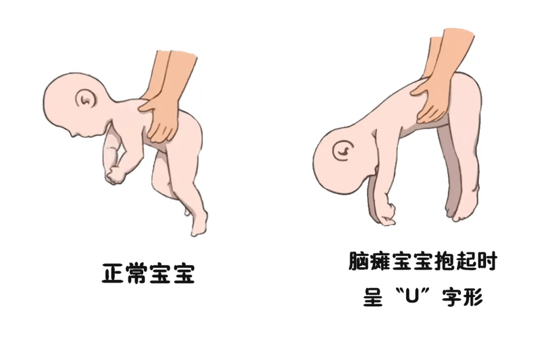 一个月新生儿脑瘫表现及其早期识别与处理